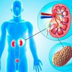 Из-за глобального потепления у людей чаще стали находить в почках камни